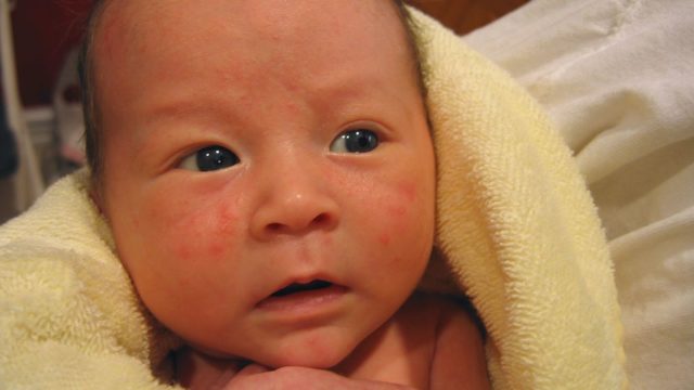 小児科医が乳児湿疹を簡単に解説します 赤ちゃんの皮膚トラブル ドクターキッド Dr Kid
