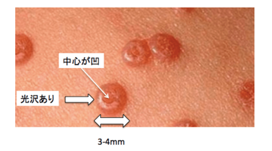 伝染性軟属腫の合併症にはどのようなものがありますか?