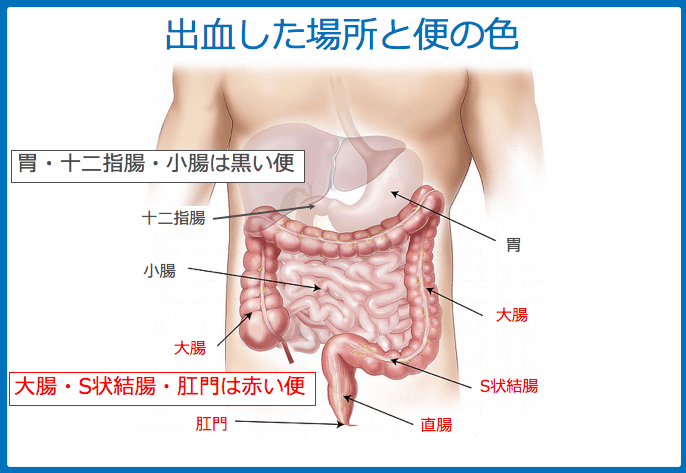 小児の血便について解説します ドクターキッド Dr Kid